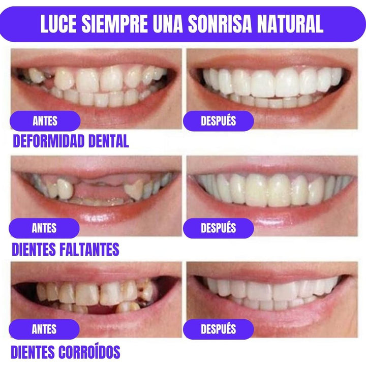 DentalGlow® Carillas de Resina para una Sonrisa Natural